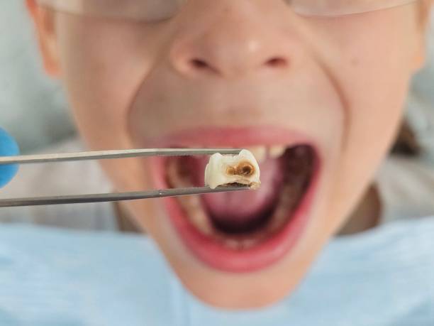 Best Broken or Cracked Tooth Emergency Dentist in Monticello, IL